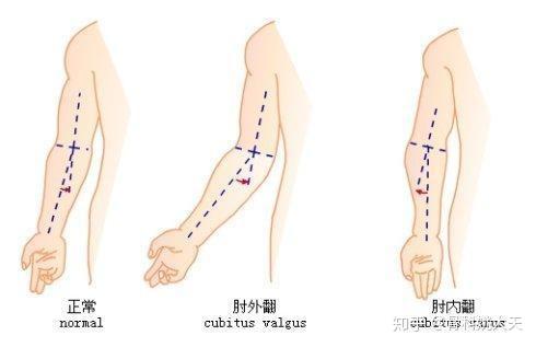 骨折复位不良 手臂这种畸形很可怕 知乎