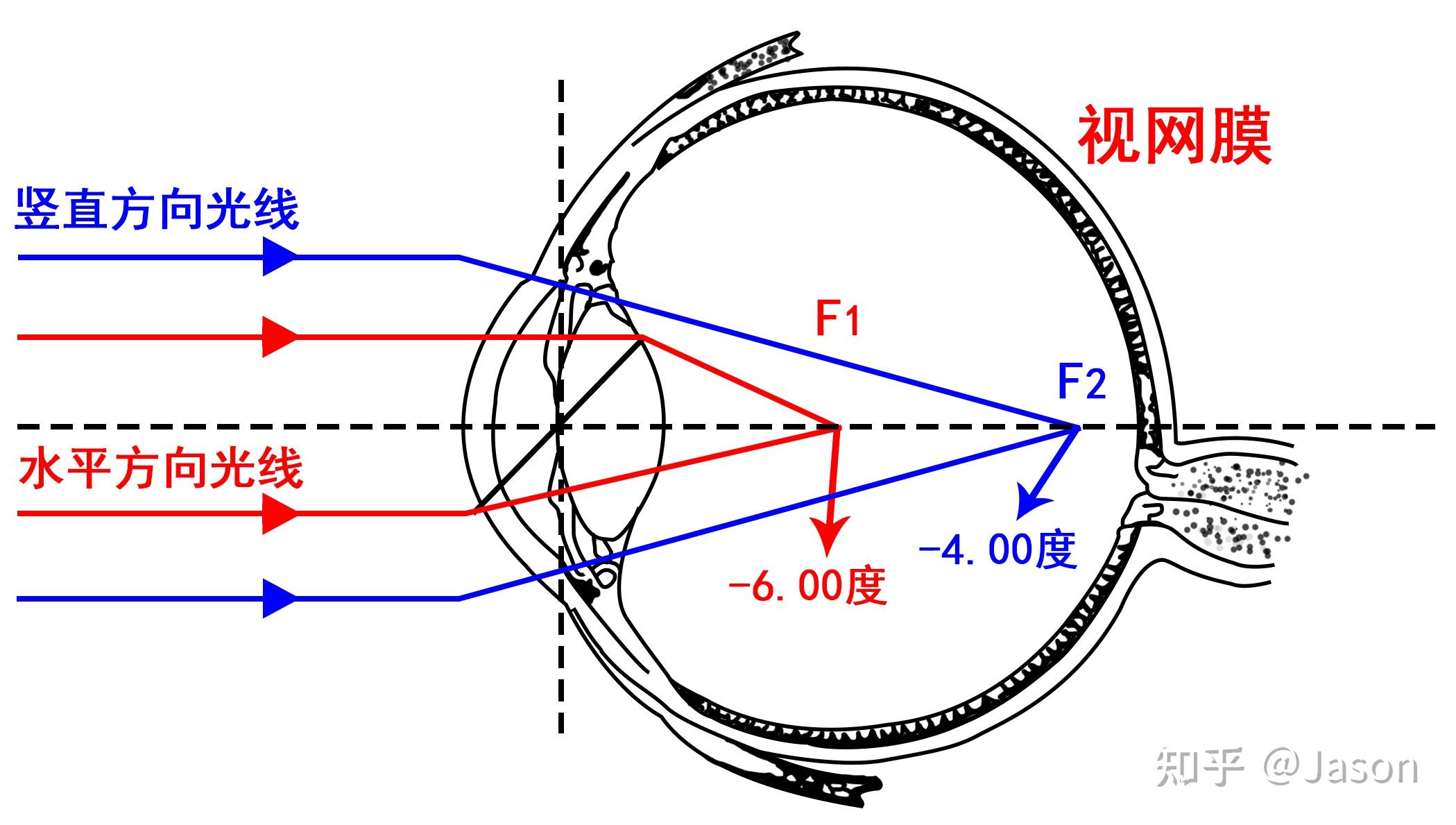 简析散光的成因,以及什么是散光的度数和轴位? - 知乎