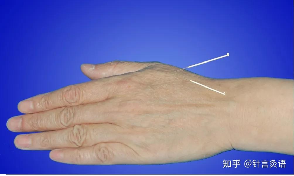 合谷针向三间穴,进针1～ 1.