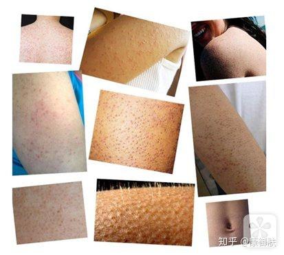 身上鸡皮肤用什么药(身上鸡皮肤用什么药膏最好)