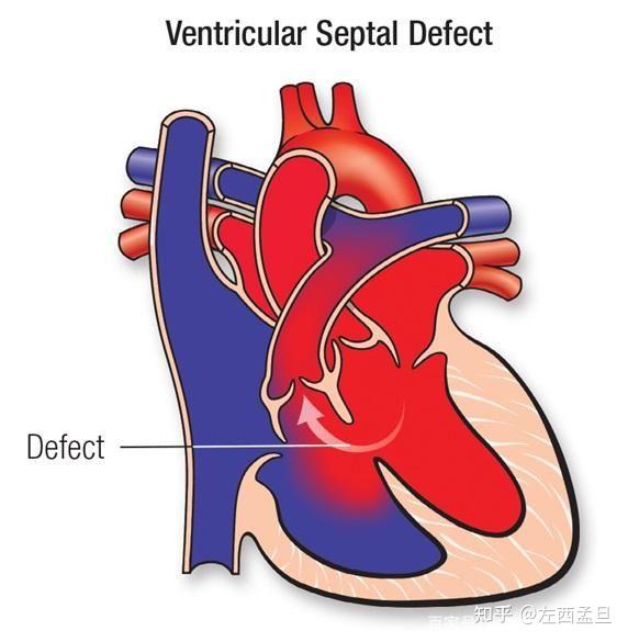 二尖瓣关闭不全,血往左心房走b.