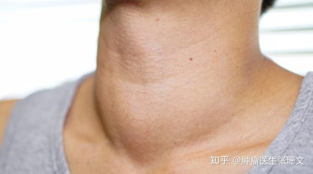 胖到没脖子你还以为只是发福吗小心甲状腺癌来敲门