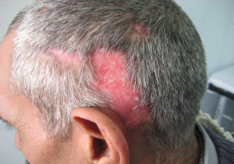 其中系统性狼疮导致的脱发,与疾病的自身免疫缺陷有关;而盘状红斑狼疮