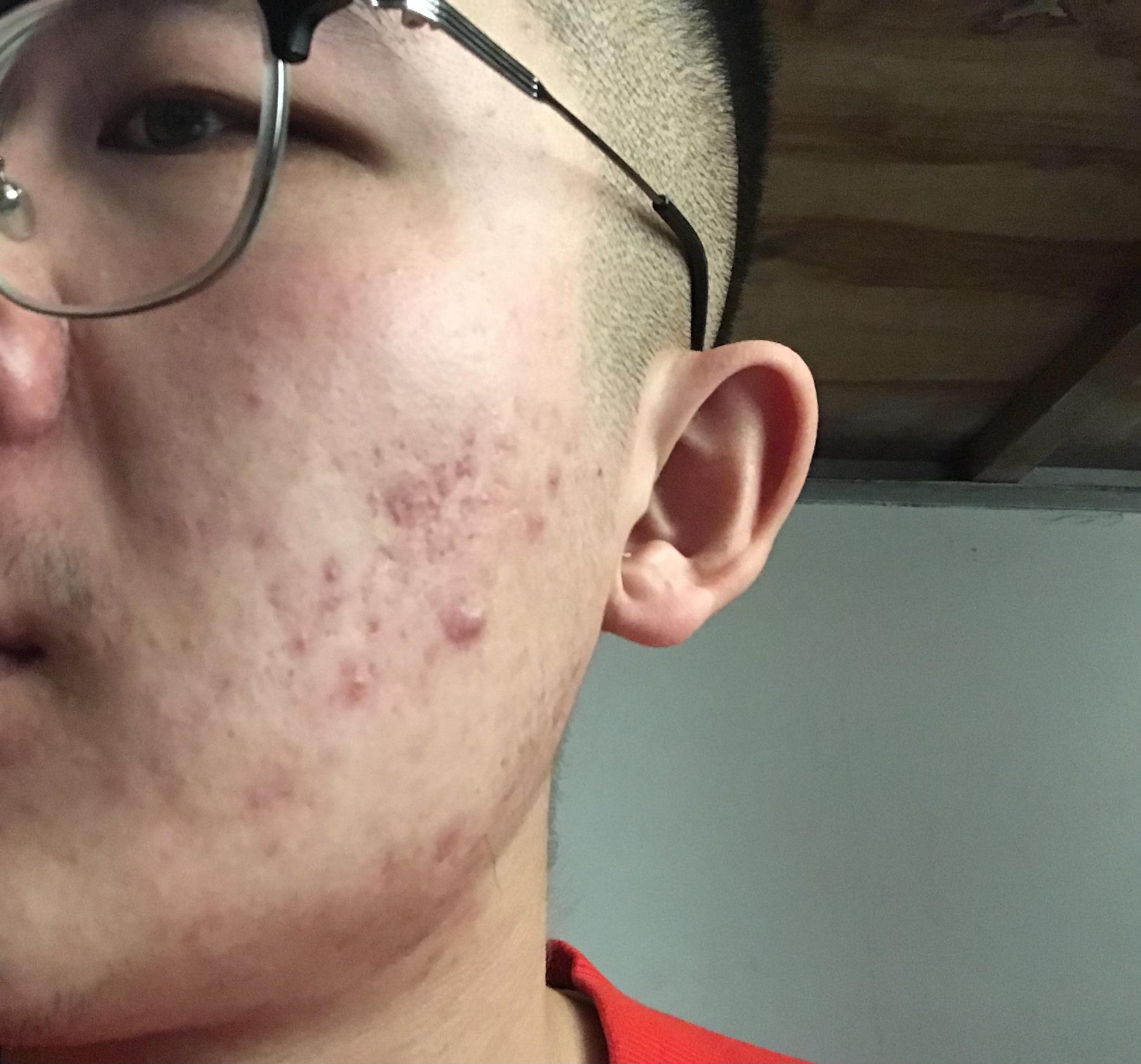 祛痘成功73七年痘痘肌,祛痘护肤有哪些步骤?