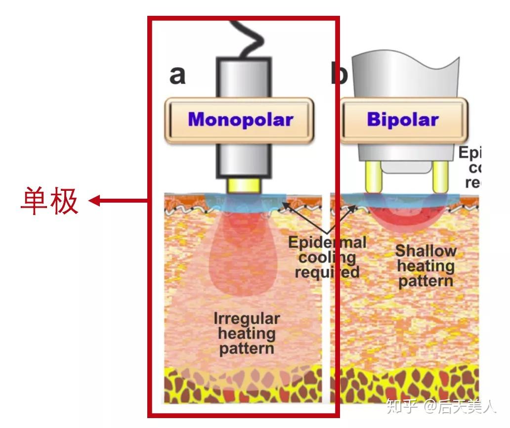 射频美容仪,大致可以分为单极和双极(多极).