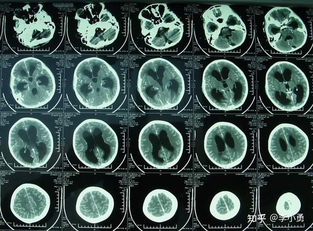 10岁女孩重度结核脑膜炎性脑积水被多家医院告知没有办法治了但经李小