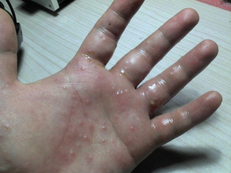 手指上长满小水泡瘙痒难耐小心汗疱疹来袭