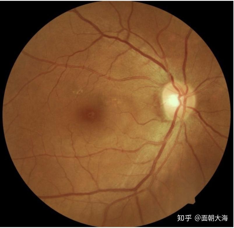 视网膜非压迫变白图片