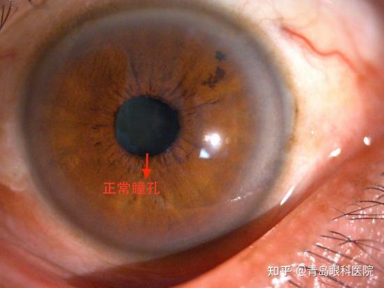 主任发现患者左眼的虹膜根部大范围离断,虹膜向上方蜷缩,瞳孔近乎消失