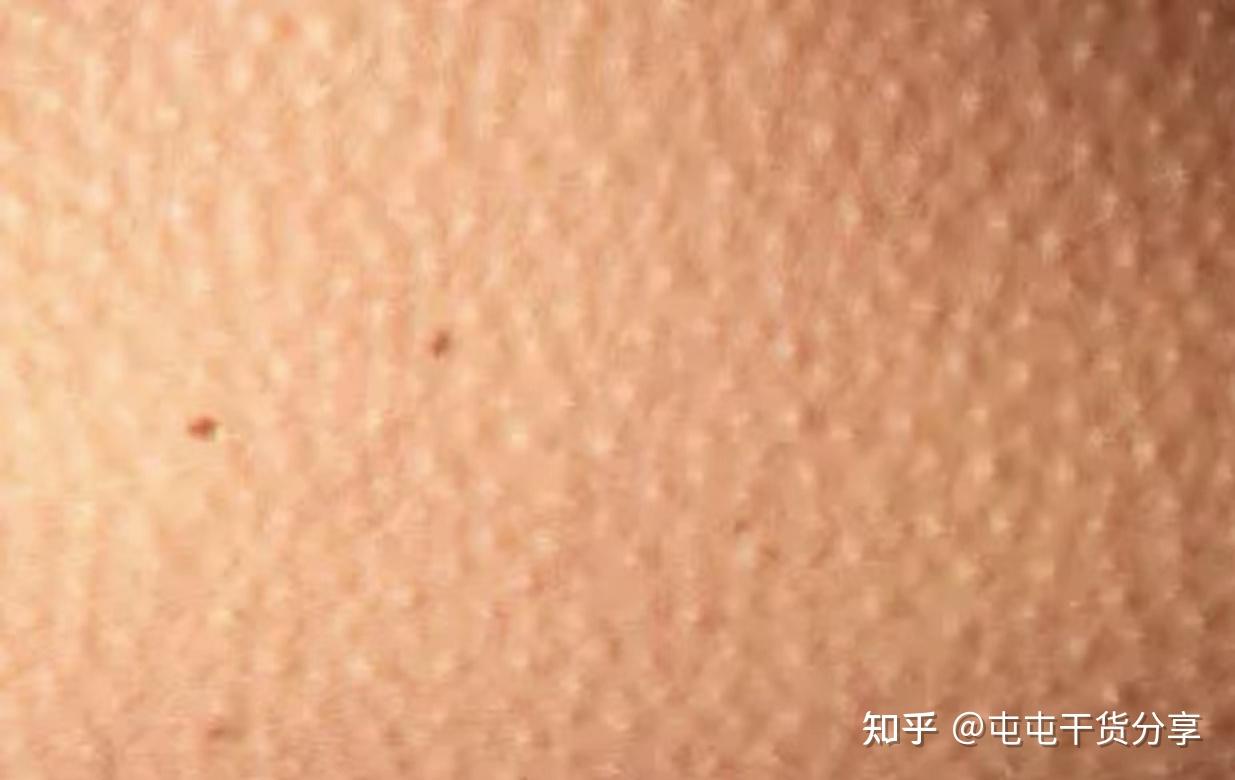 痘痘妹子必备 - 知乎