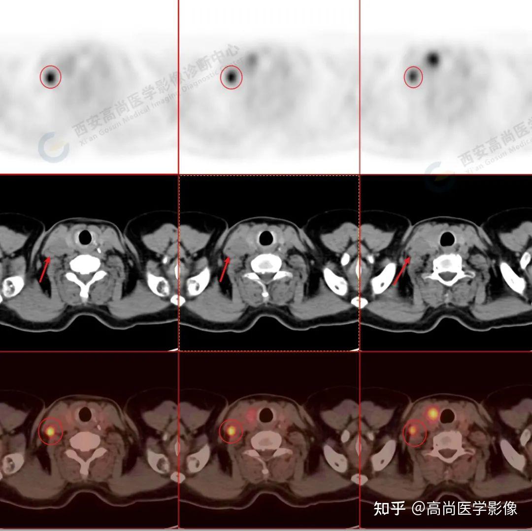 18F- FDG PET/CT检查“无意中”发现的甲状腺癌4例【高尚医学影像】 - 知乎