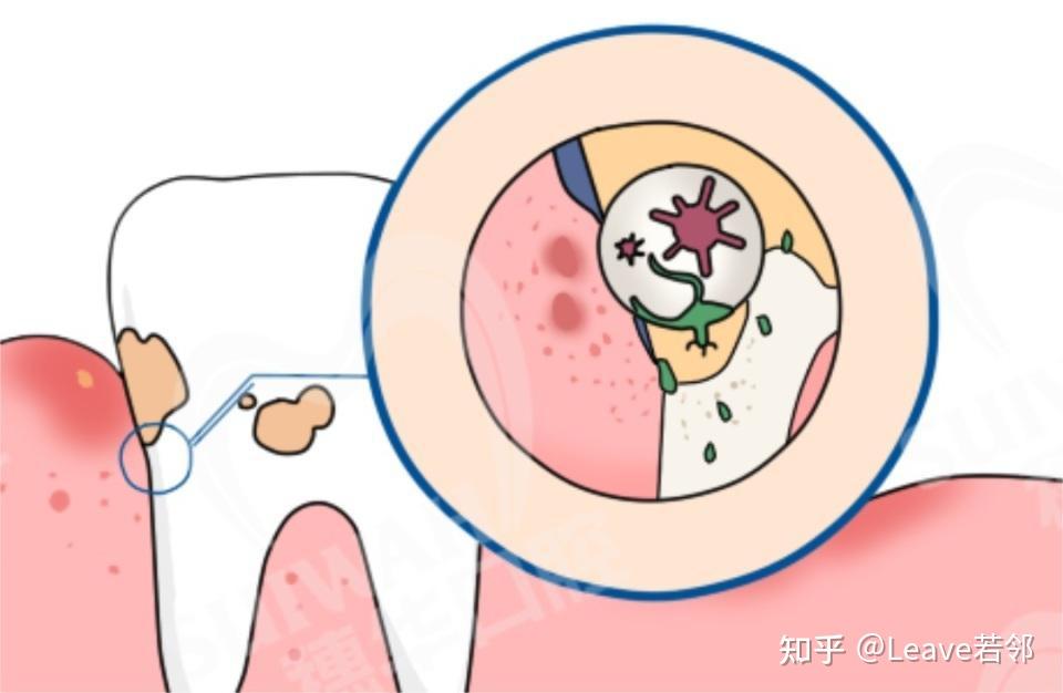 我国成年人牙周健康者不足一成,中重度牙周炎患者高达62