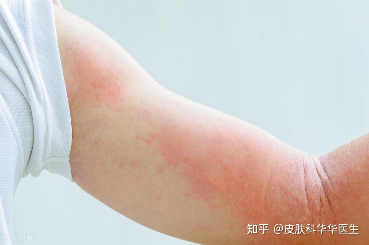 丘疹性荨麻疹（虫咬皮炎）持续恢复中，分享1个月抗疹经历 - 知乎