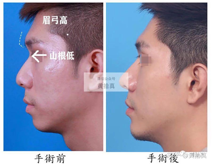 隆鼻术后通天鼻阿凡达盘点山根的重要性