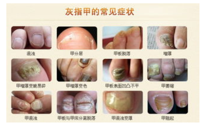 得了灰指甲一个传染俩没夸大灰指甲治疗要趁早