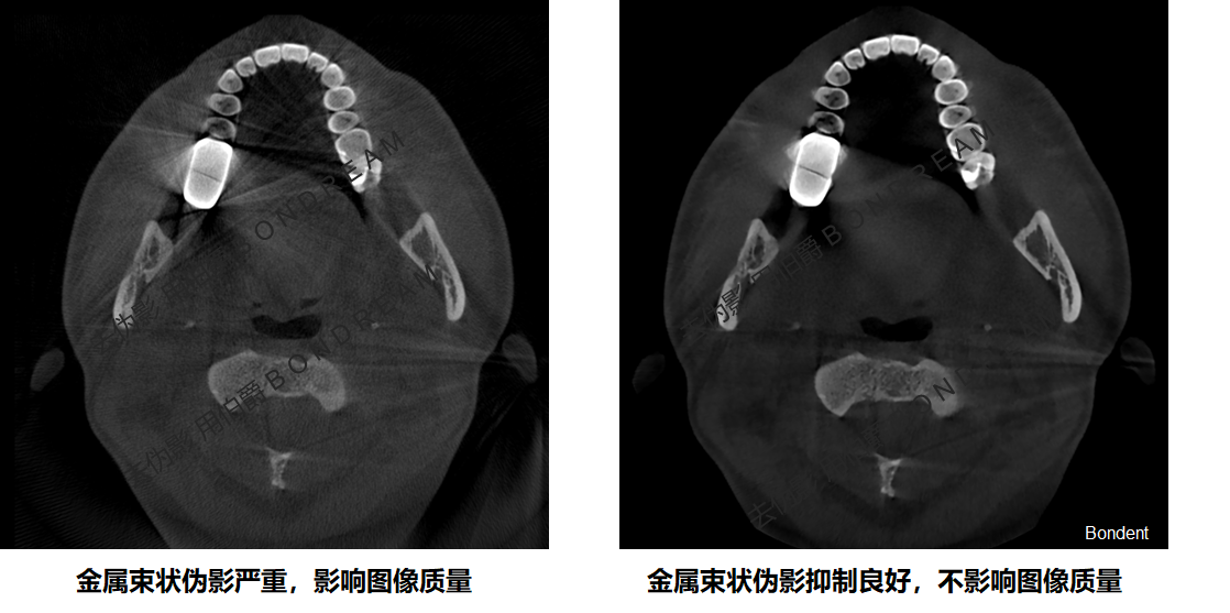 cbct影像的金属伪影对比(病例1)cbct影像的金属伪影对比(病例2