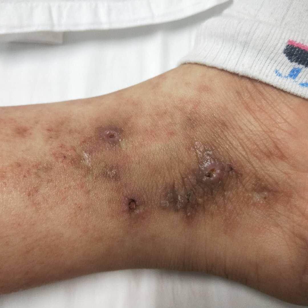 感谢苍天我的青斑血管炎痊愈了