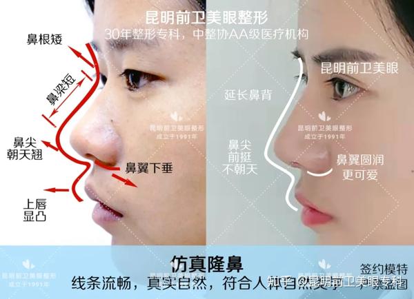 清秀的鼻背、小巧的鼻尖、圆润的鼻翼,如果这些都是你想要的,就选这款鼻子 - 知乎