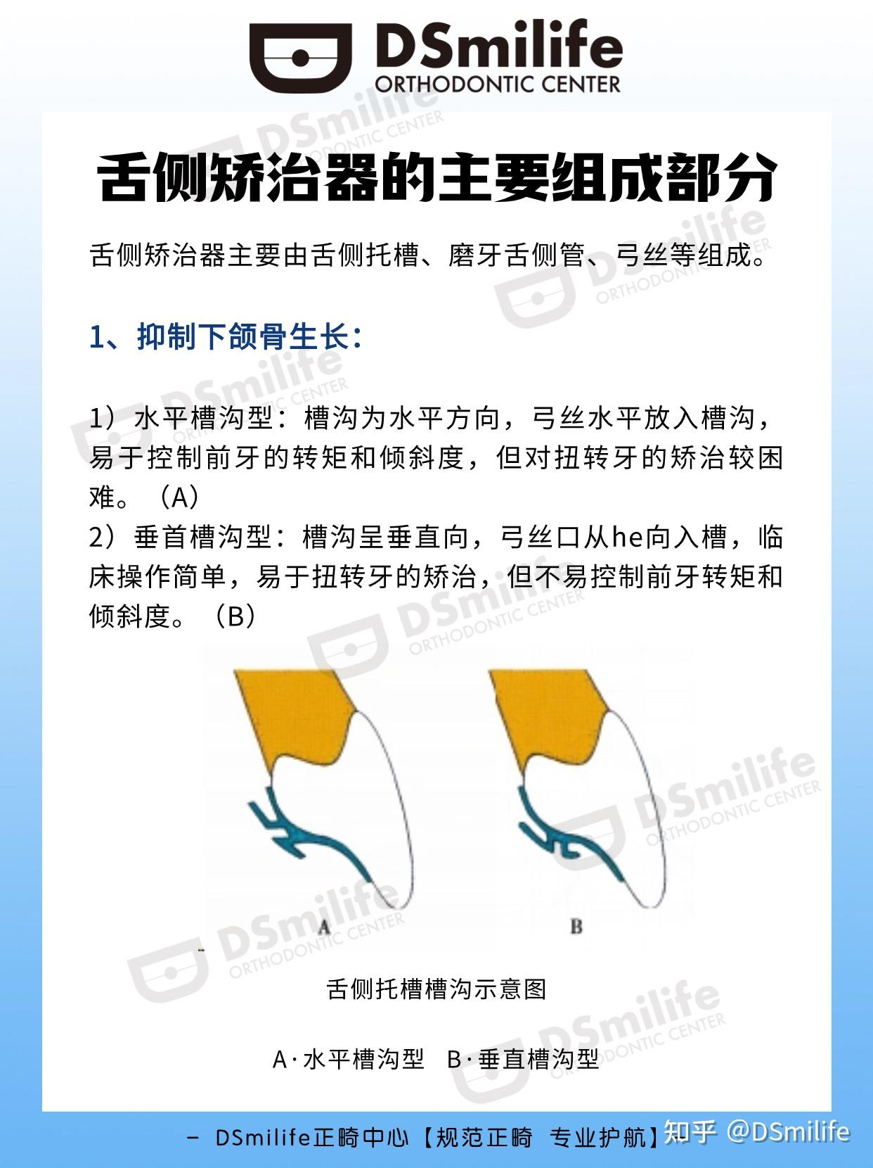 DS正畸|舌侧矫治器的主要组成部分 - 知乎