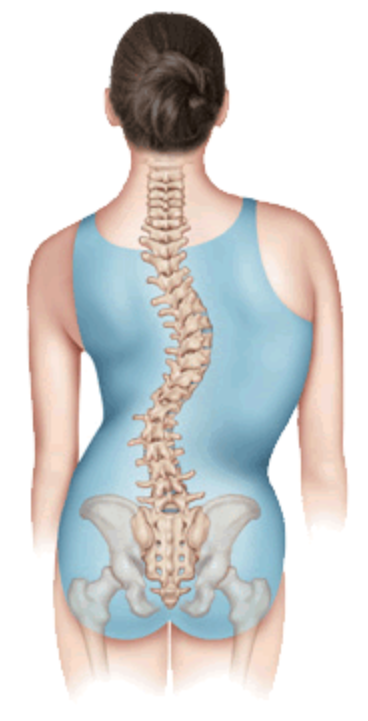 尽管大多数脊柱侧弯是特发性的(所谓特发性是指目前还没有确定的病因)