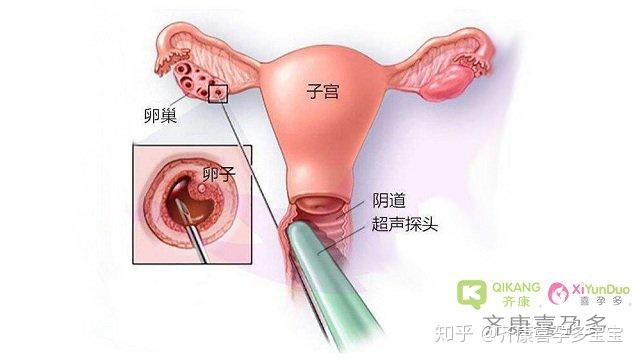 做试管婴儿，取完卵子之后多久来例假正常？ - 知乎