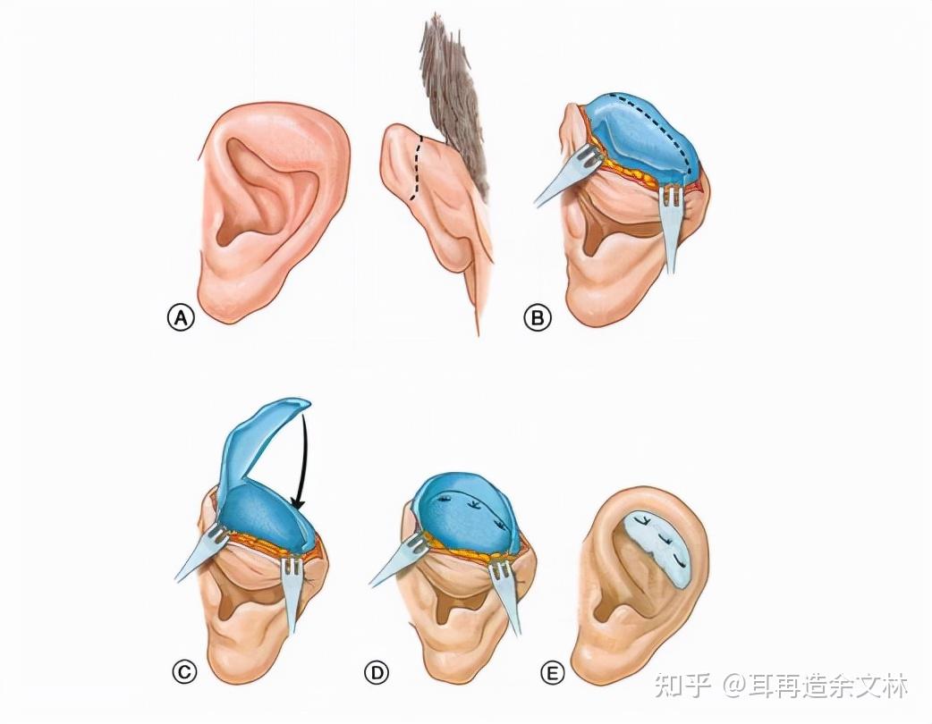 自然大耳朵针灸模型 针灸耳按摩模型7cm 耳穴 耳部经络穴位 模型-阿里巴巴