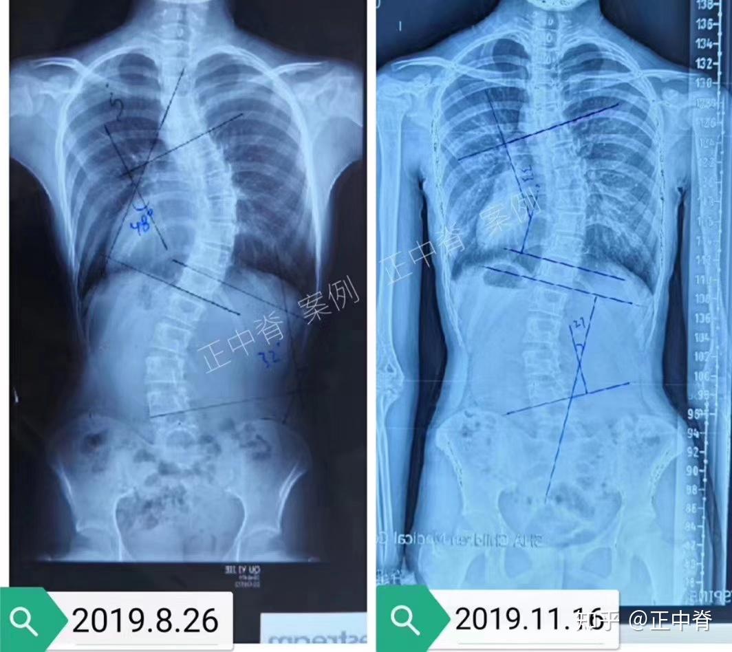 青少年脊柱側彎保守治療效果對比