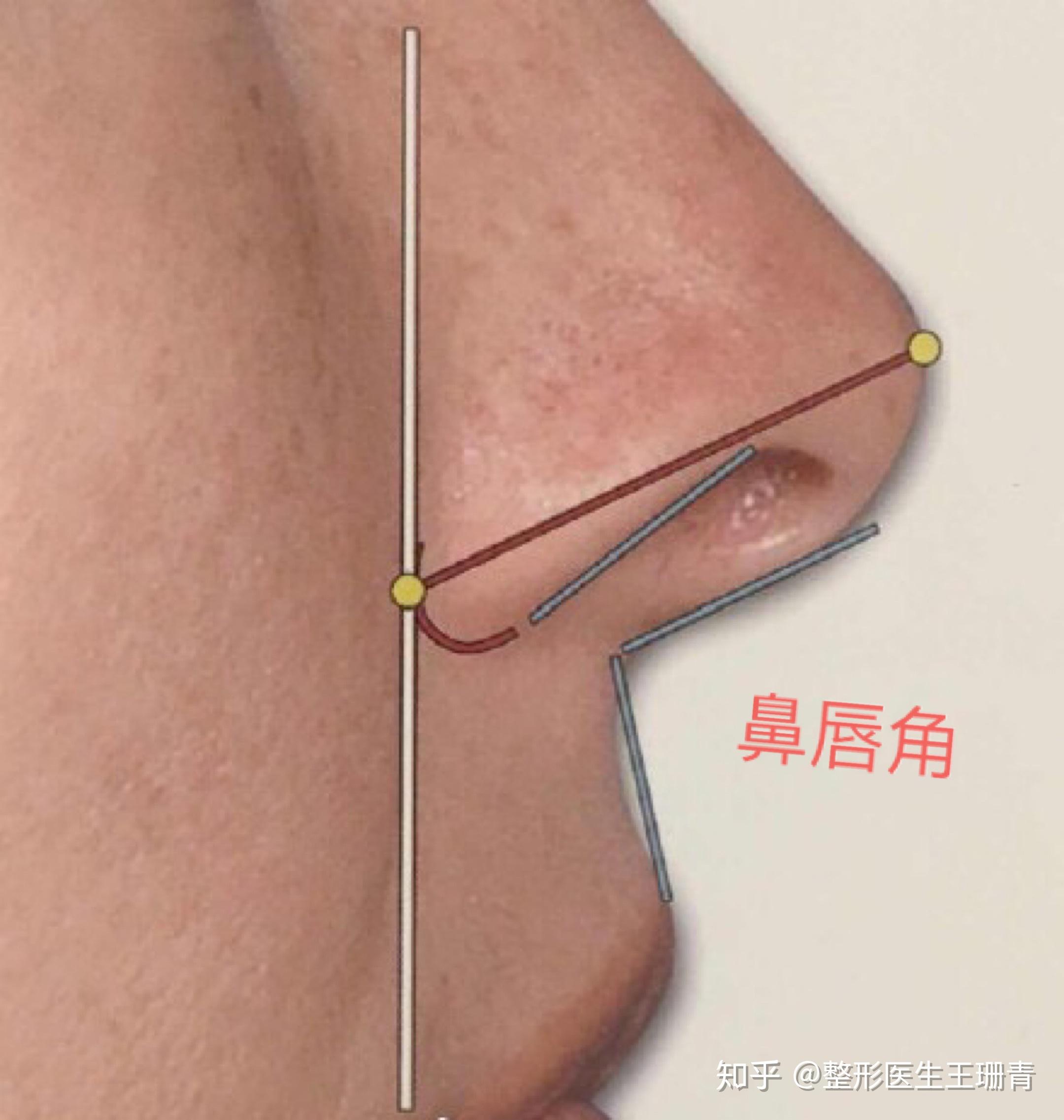 鼻唇角这个概念好像很少被提及到,它是指鼻小柱和上嘴唇之间的角度.