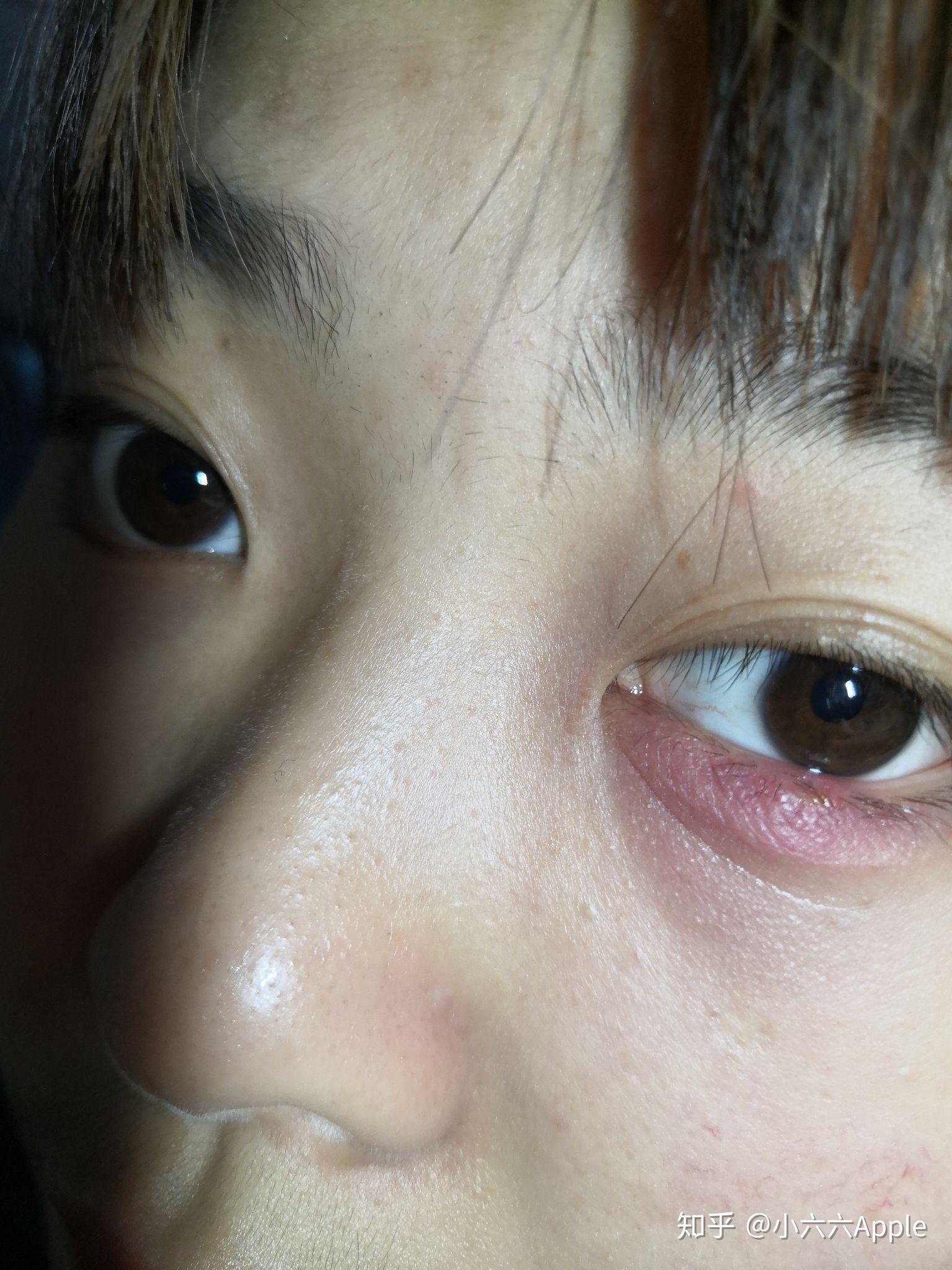 请问这样眼睛红肿是什么症状？_百度知道