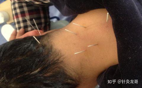 颈椎富贵包和富贵没有关系都说针灸可以消除具体治疗是什么