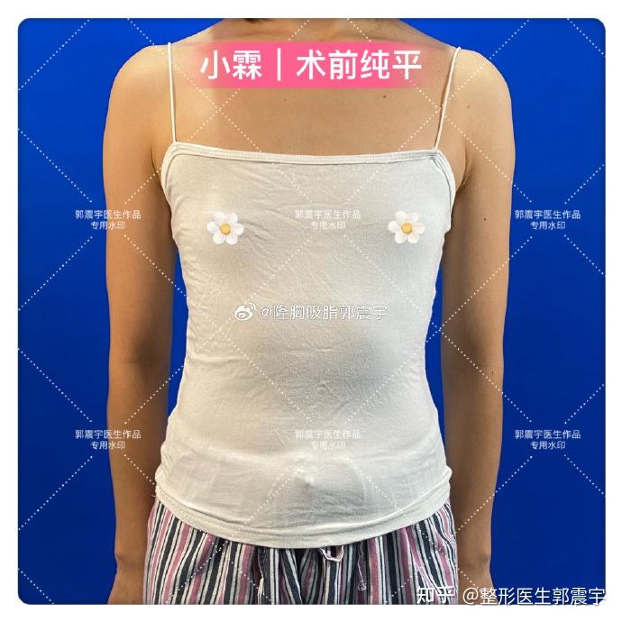 什么是复合式隆胸？哪些情况适合复合隆胸？ 知乎 
