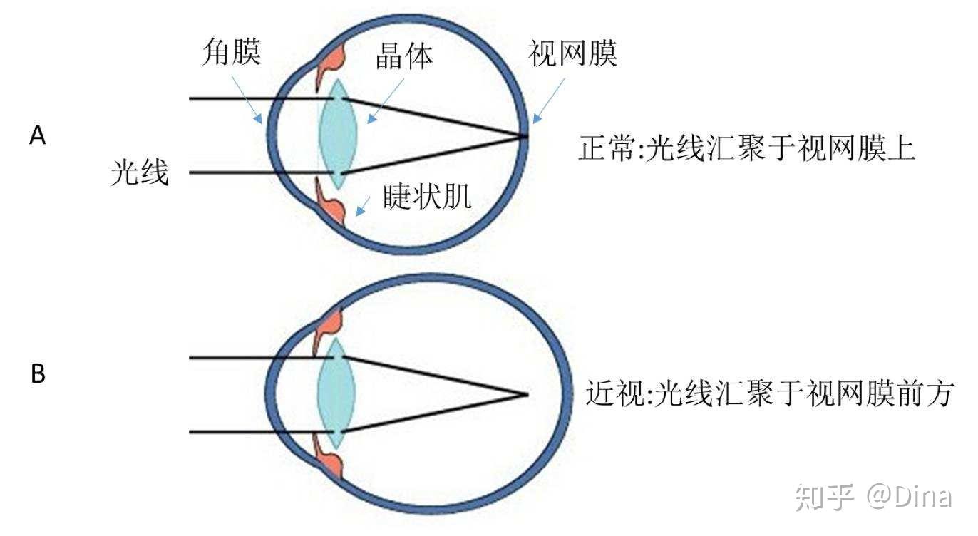 近视眼镜是什么原理是凹透镜还是凸透镜(3)