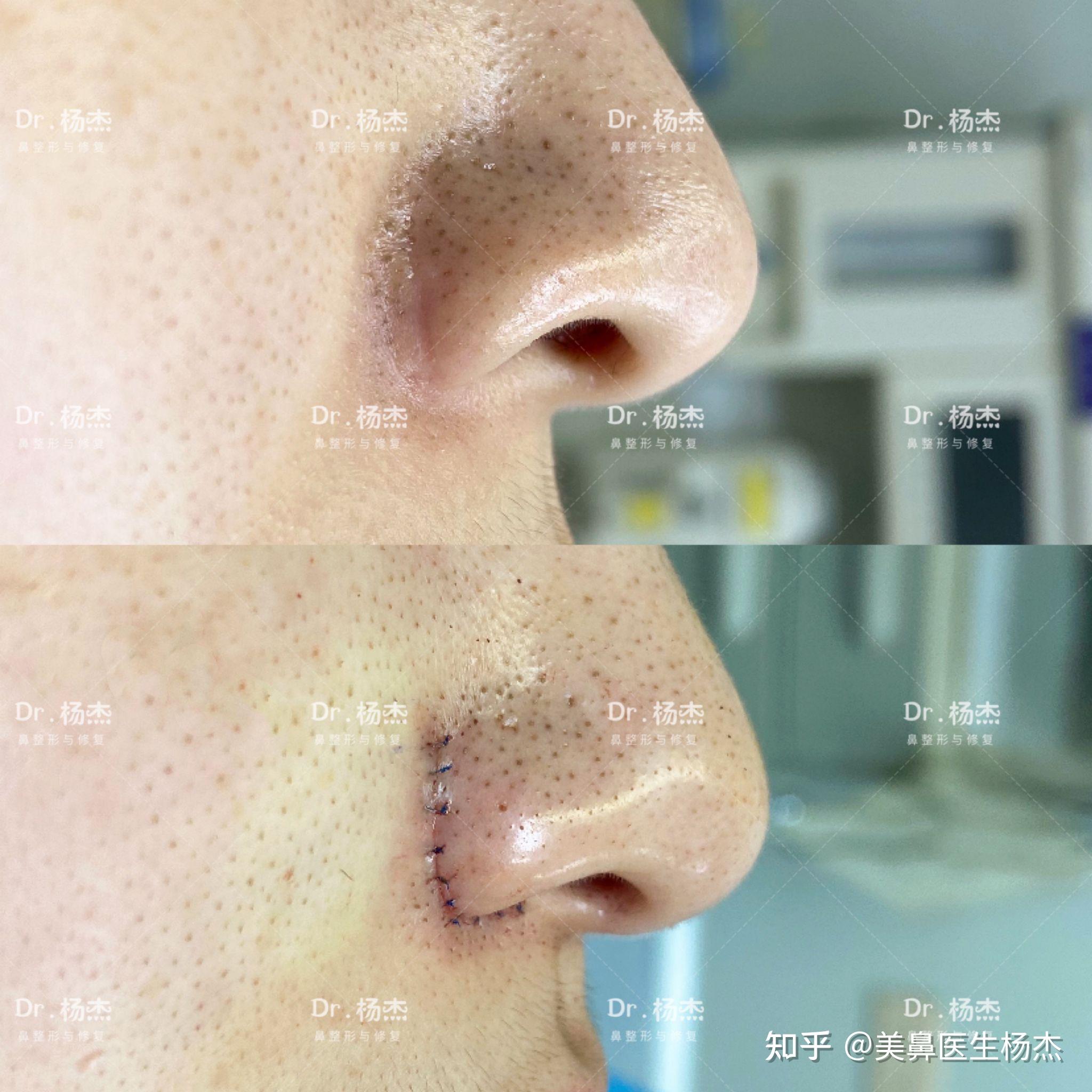 【内外联合鼻翼缩小】 术前情况:术前1年行鼻翼外切术,术后遗留疤痕