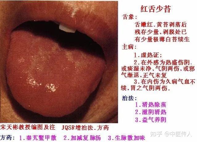 高清舌诊图解:各种临床证型舌象图谱大开眼界 - 知乎
