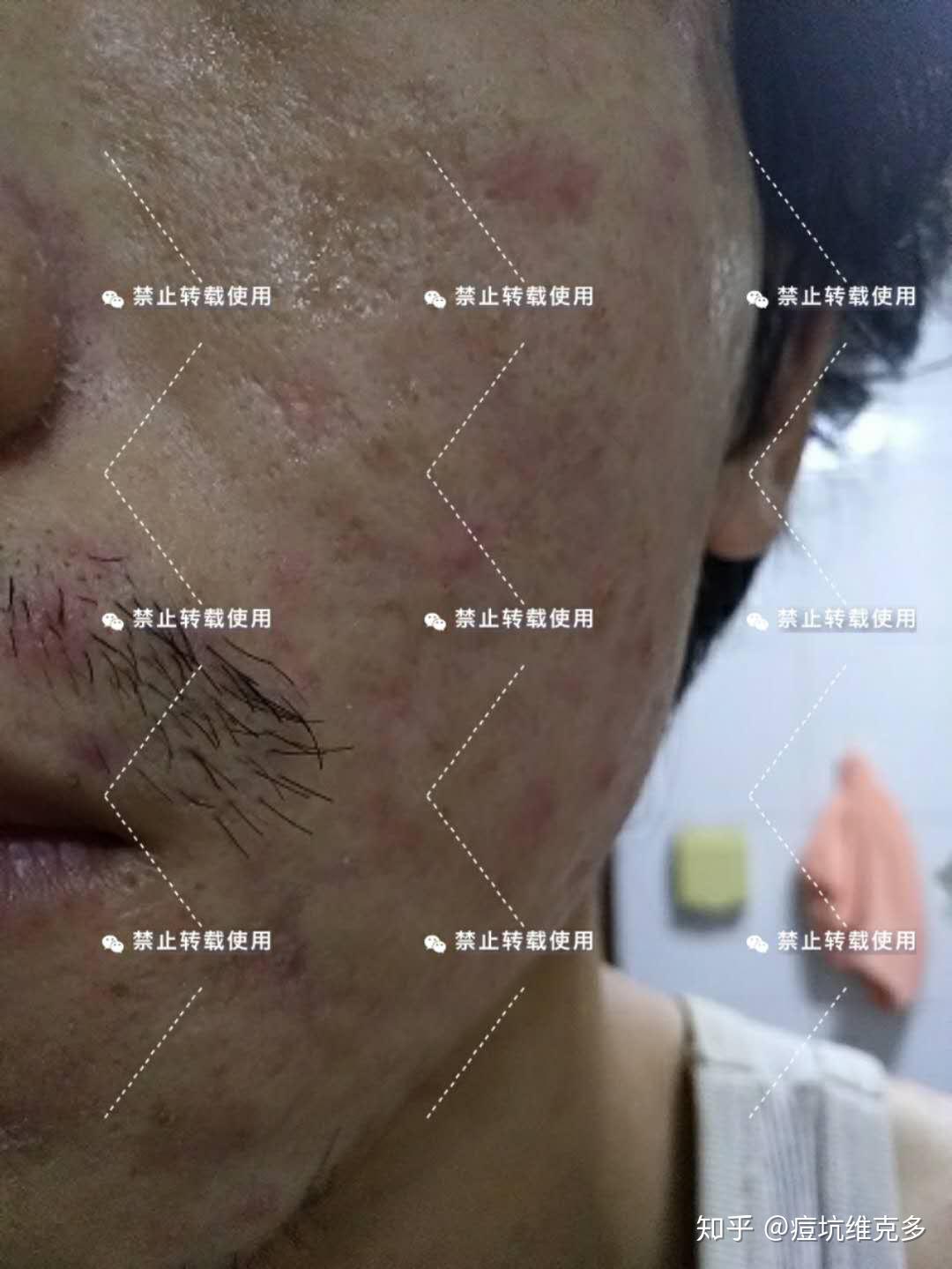 脸上的痘印痘坑怎么才能修复好？ - 知乎