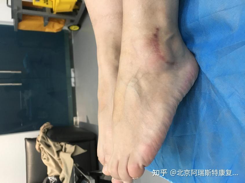 双踝仰卧位背屈:8°,双踝仰卧位跖屈:45°,双踝内翻:30°,双踝外翻