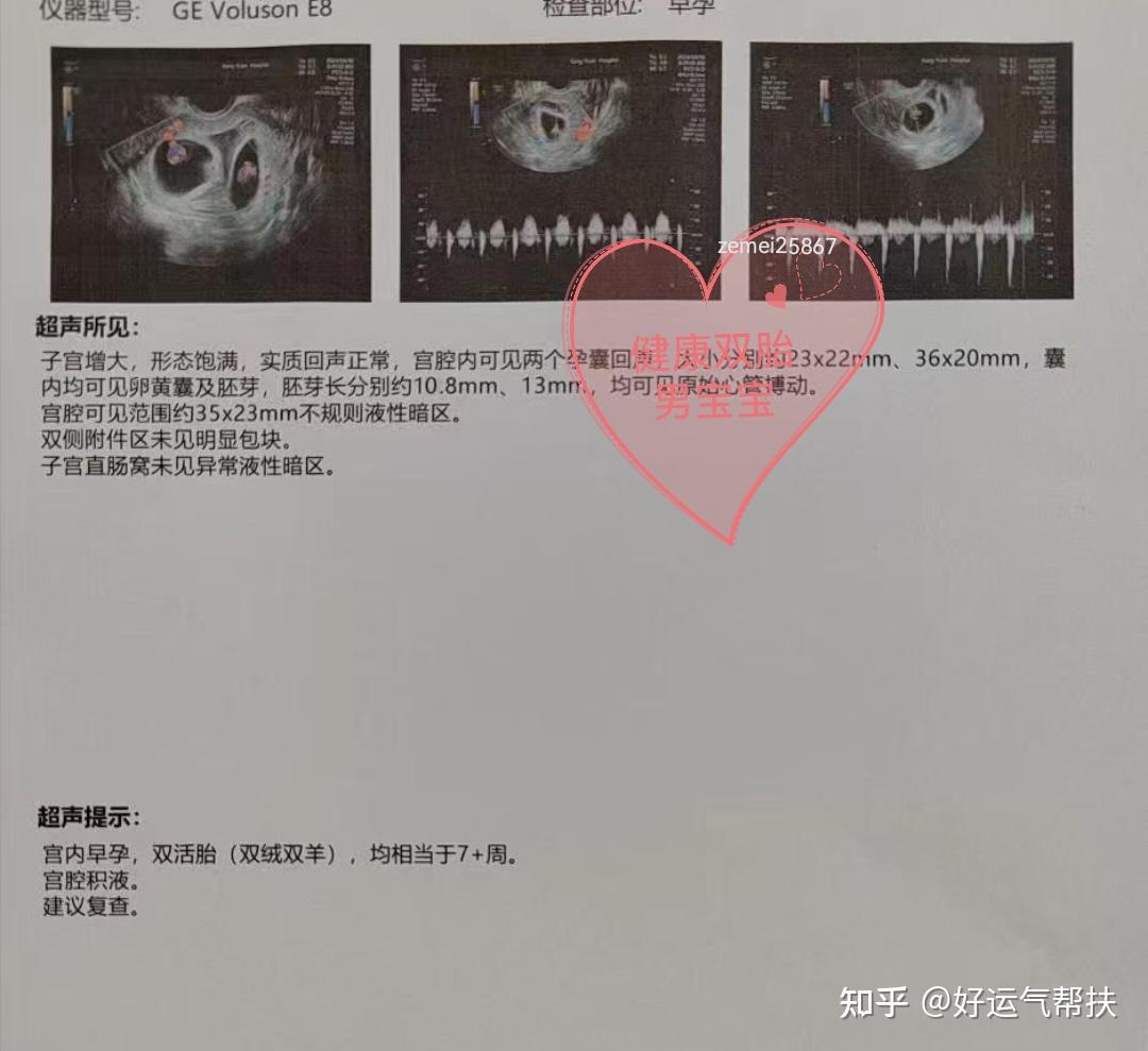 到底有多幸运才能怀上双胞胎？ - 知乎