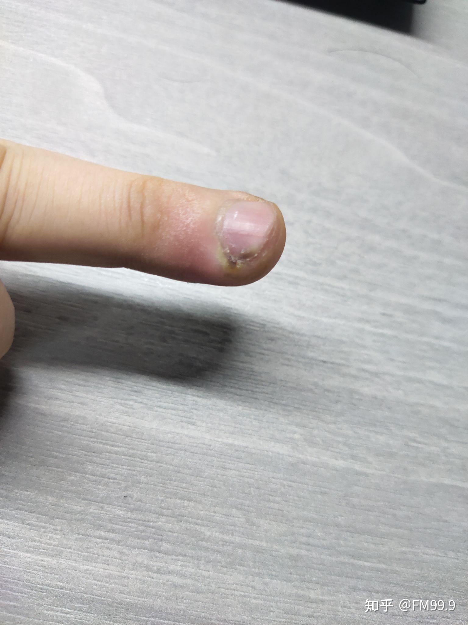 手指甲甲沟炎症状图片图片