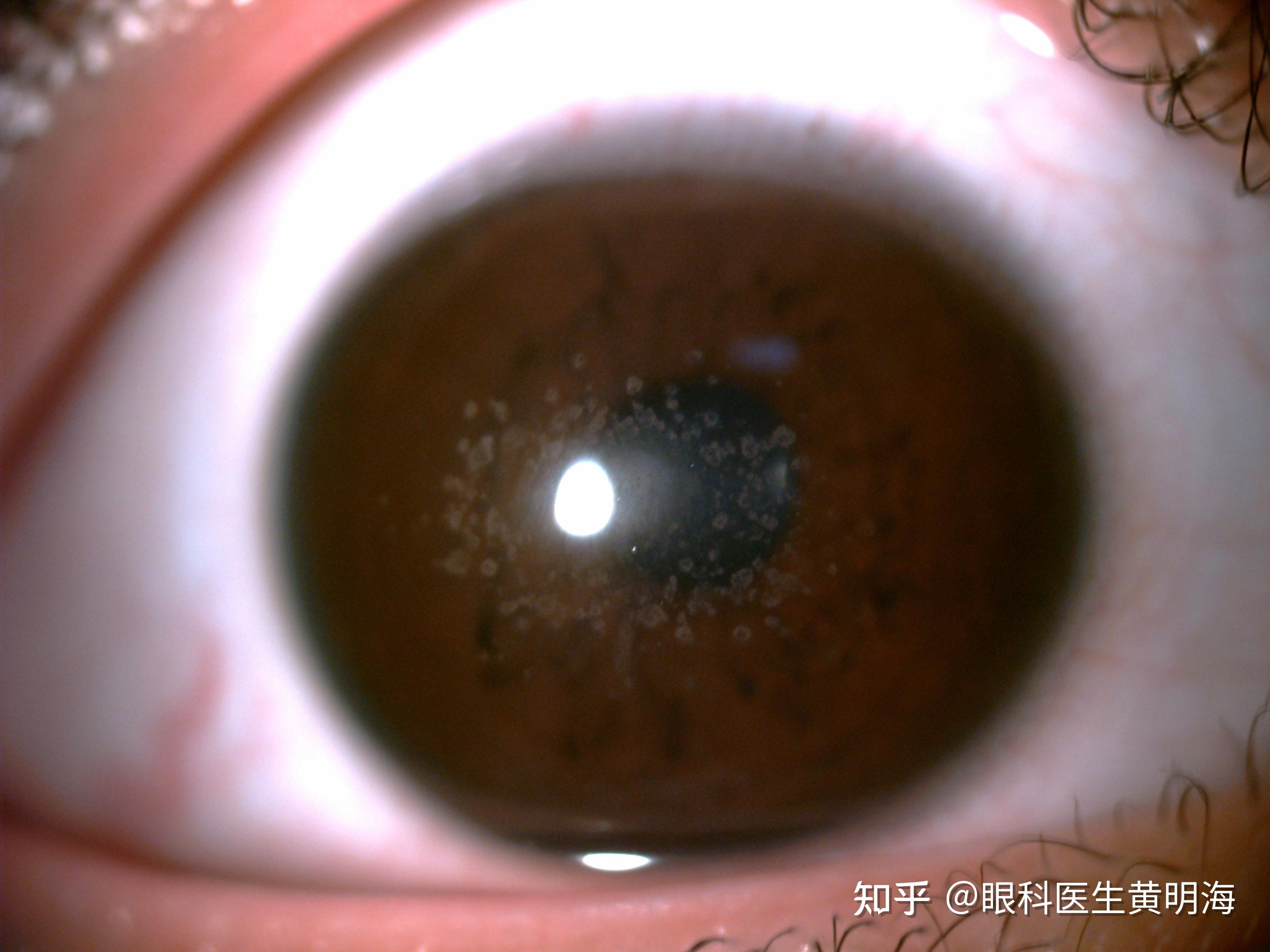 眼睛看不清,竟然是"营养不良"