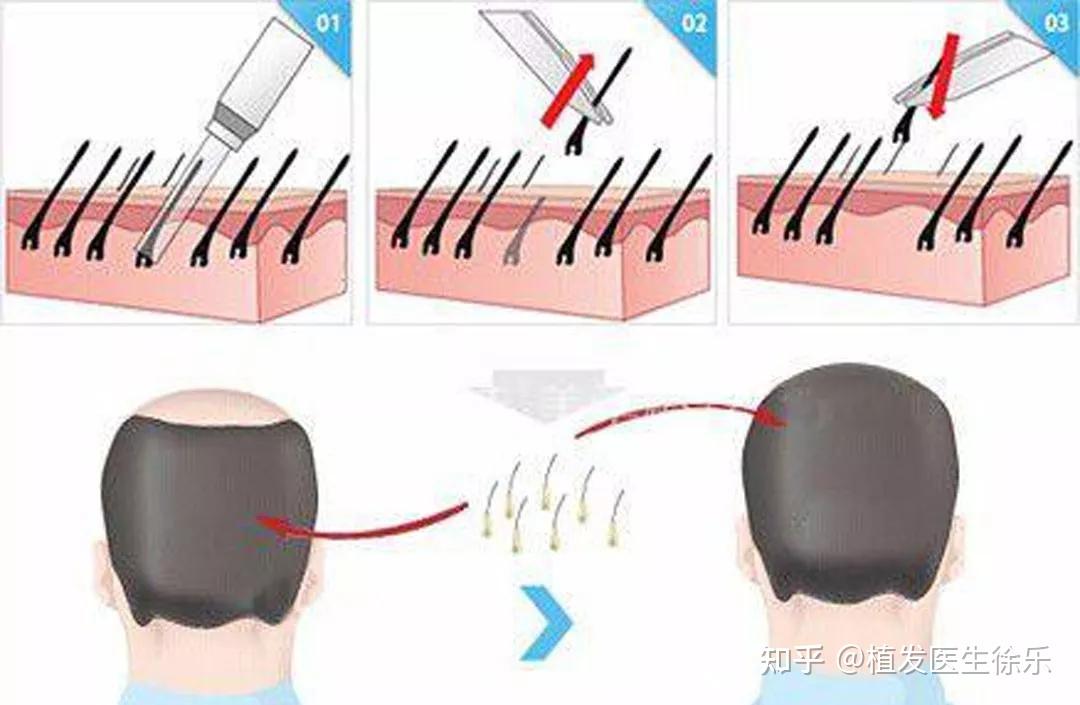 广州植发的医院医生口碑好的有哪些？价格大概多少钱？ - 知乎