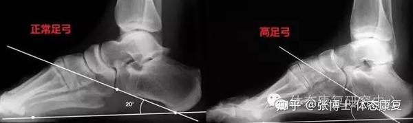 你的足弓正常吗 高足弓形成机制与危害 知乎