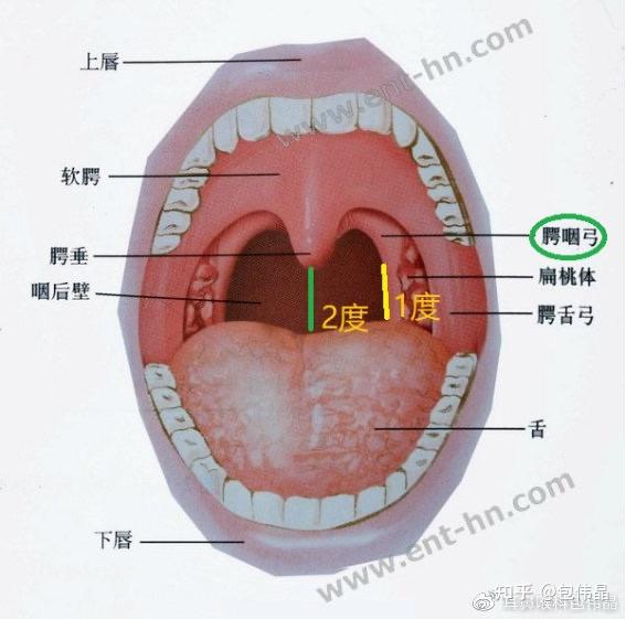 腭咽弓和腭舌弓图片