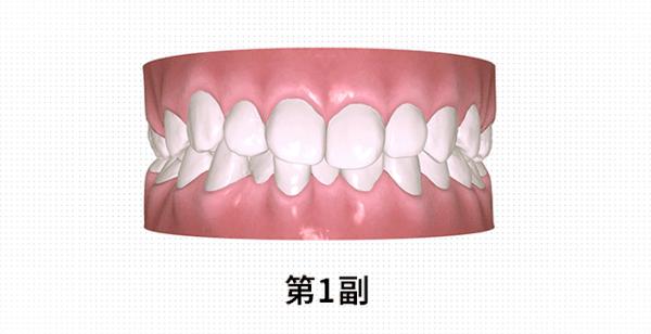 播放鍵7415就可以提前看到你的牙齒是如何一步步移動到目標位的