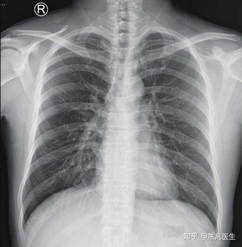 小片子肺部图片