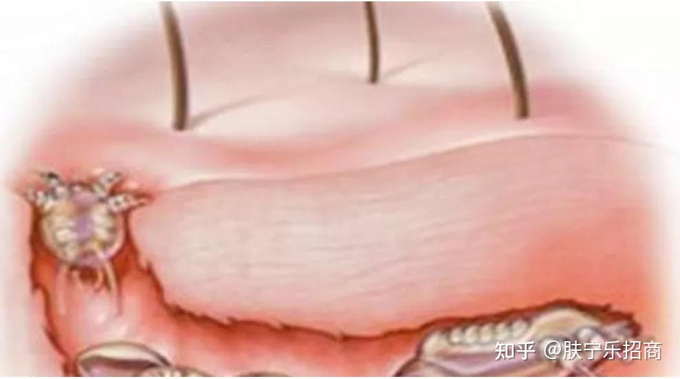 教你走出误区——疥疮小科普 - 知乎