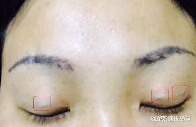 做埋线双眼皮为保证手术效果大都使用尼龙线,很少出现排异现象,但也