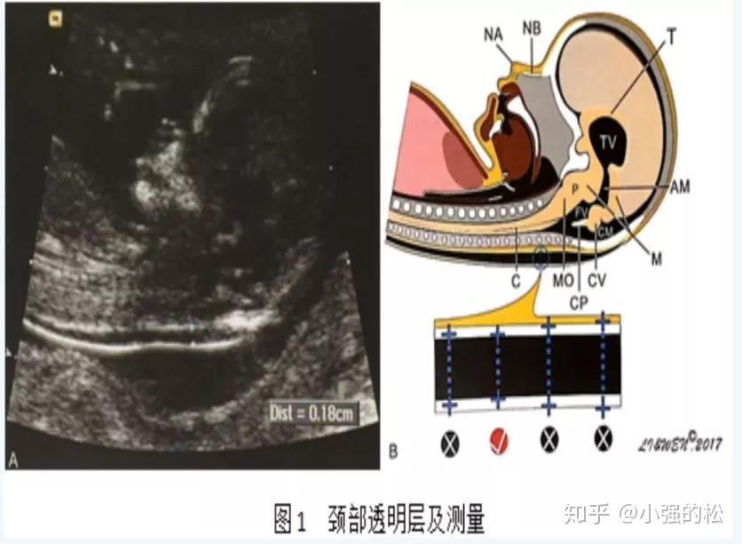 怀孕了，nt结果怎么看？ 知乎