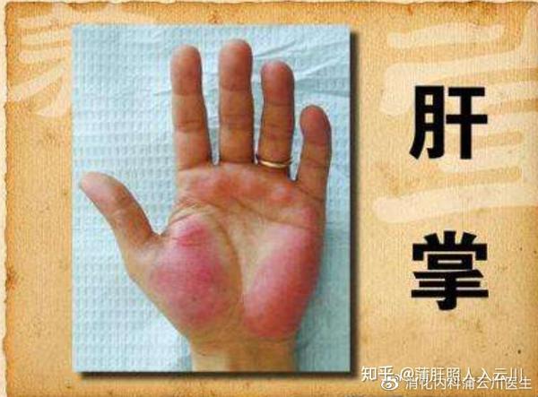 如身上出现肝掌 要注意可能是肝脏出现了病变 出现肝掌和蜘蛛痣 蜂产网