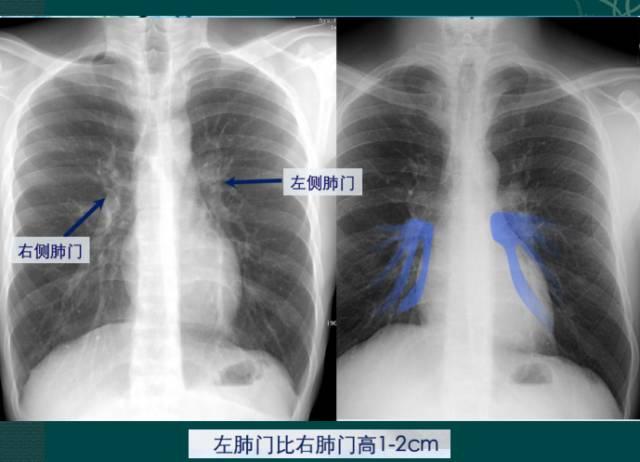 读完此文,终于学会看胸片了