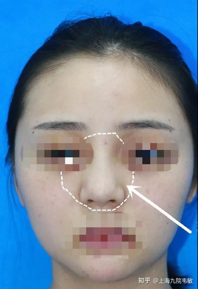 而这个吸收-代谢的过程中,玻尿酸自然而然地也会向四周有一定程度的